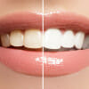 Teeth Whitening