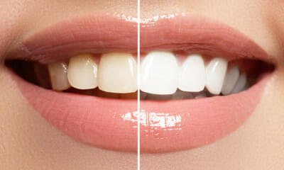 Teeth Whitening